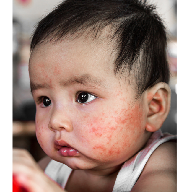 Alergi Pada Bayi Apa Obatnya